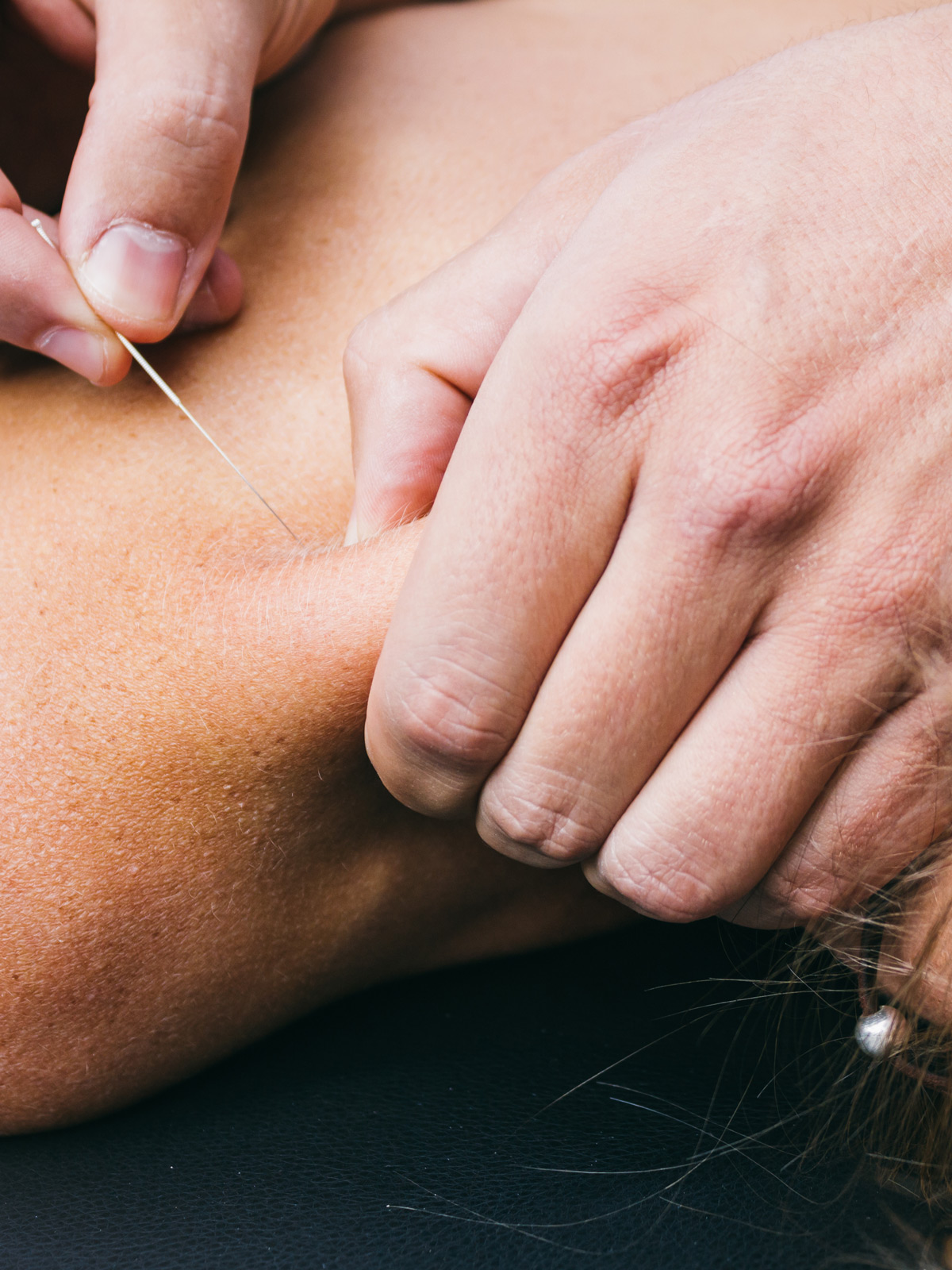 Dry needling being done on a patient.